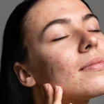 Dry-Skin-but-Breaking-Out-Heres-Why-How-to-Fix-It
